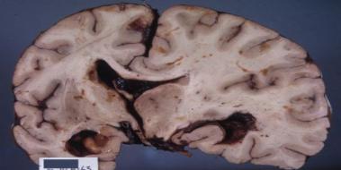 Hipoksik Beyin